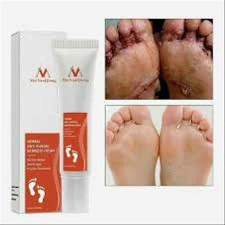 كريم علاج طفيليات القدم