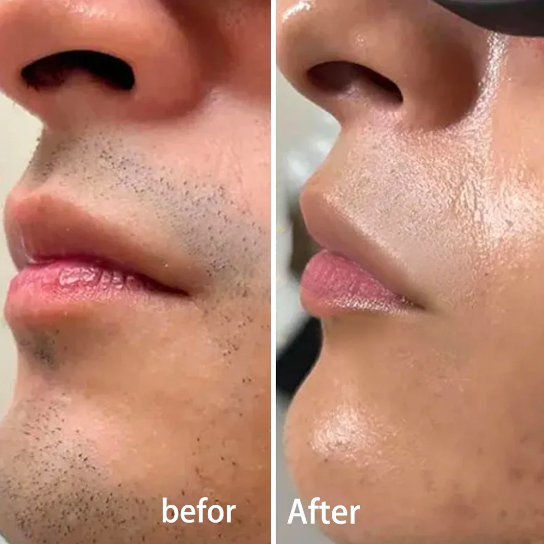 Épilation laser transfrontalière à domicile