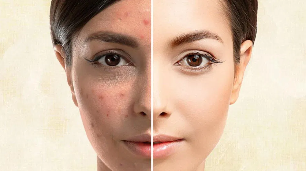 كريم أكريتين المضاد لحب الشباب والبقع