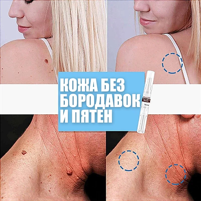 Безболезненное удаление бородавок и пятен — ваш портативный Beauty-Pen для кожи ✨