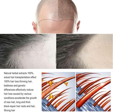 بخاخ الشعر بالزنجبيل تقنية صحية فعالة لتقوية بصيلات الشعر بأنواعه (تصفية 2025)