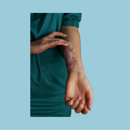 كريم الحروق