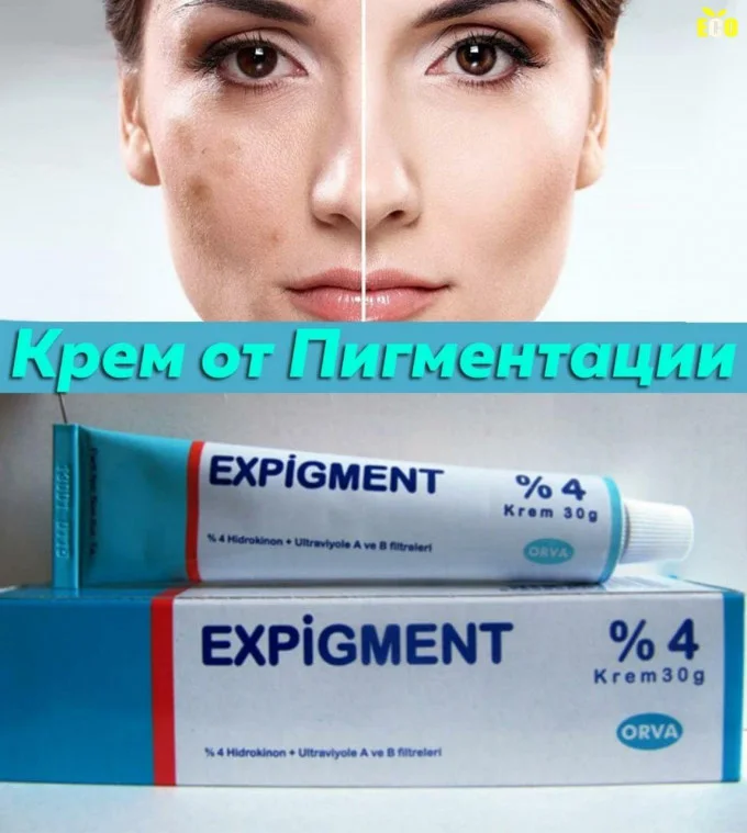 كريم التفتيح التركي الاصلي EXPIGMENT 4%