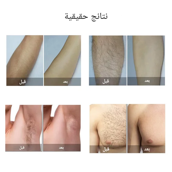 جهاز إزالة الشعر بتقنية IPL Laser  آمناً وفعالاً