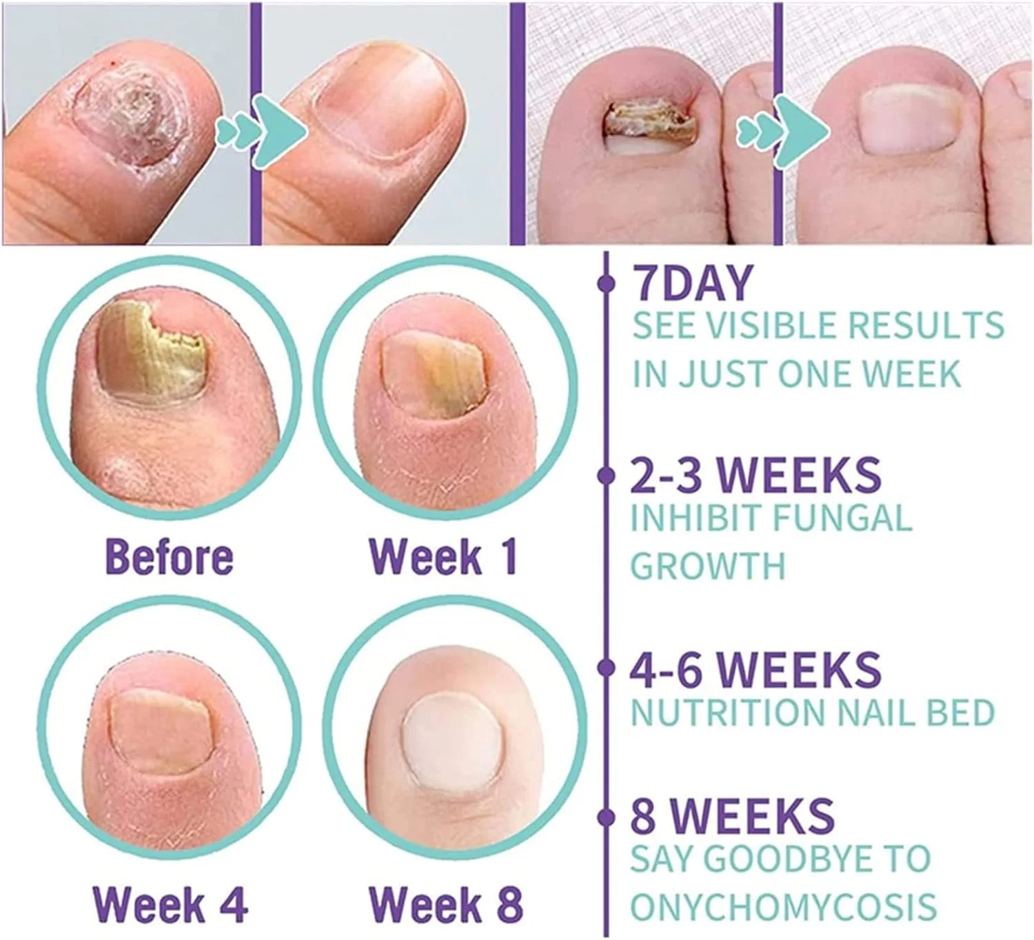 Spray Mycose Des Ongles