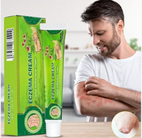 كريم طبي للتخفيف من الحكة  والاكزيما