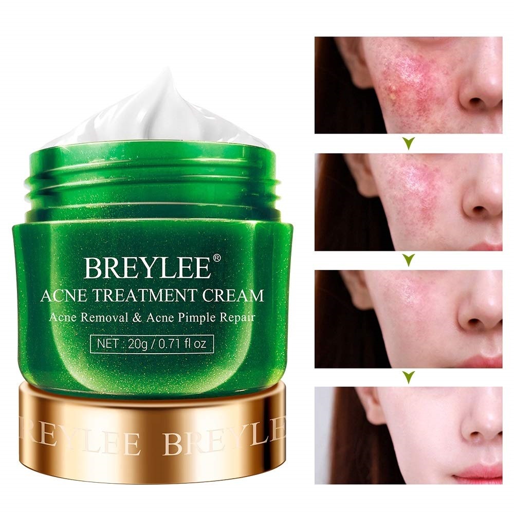Acne Treatment Cream