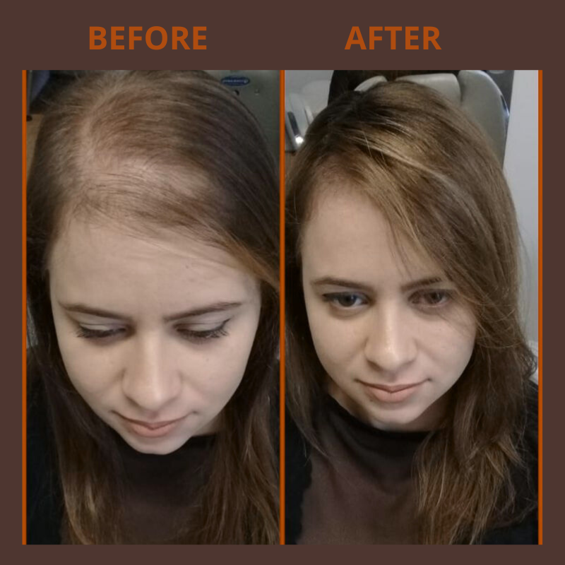 ANTI HAIR LOSS PACK