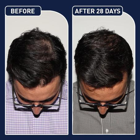 رذاذ تسريع نمو الشعر