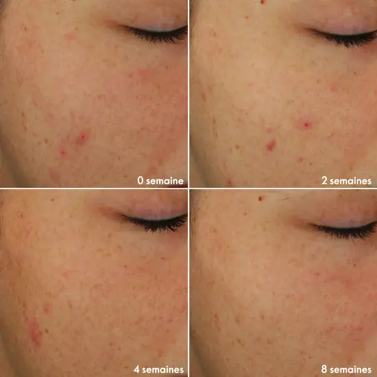 Routine Légère Novage+ Blemish + Age Defy