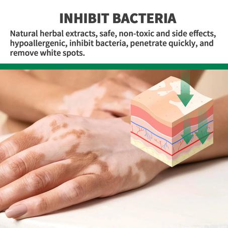 مرهم علاج البهاق