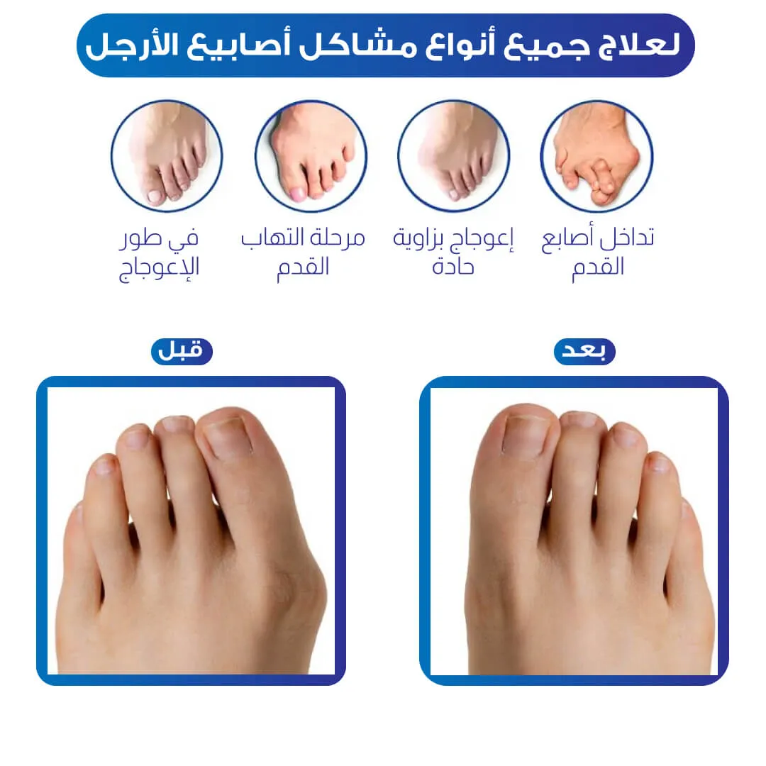 مصحح أصبع القدم الكبير