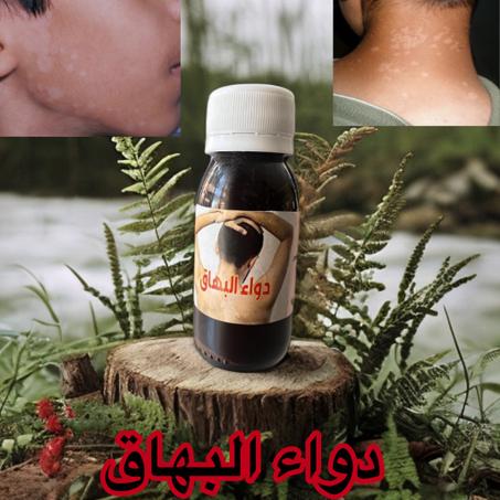 زيت البهاق مكون من مواد طبيعية فعالةو يعطي نتائج سريعة عن تجربة شخصية