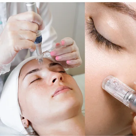 Microneedling