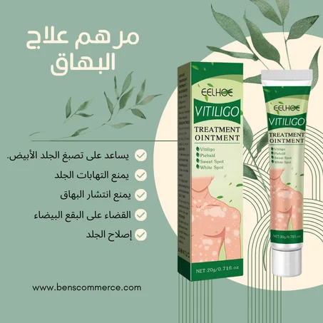 مرهم علاج البهاق