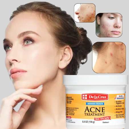 كريم ديلا كروز لعلاج حب الشباب