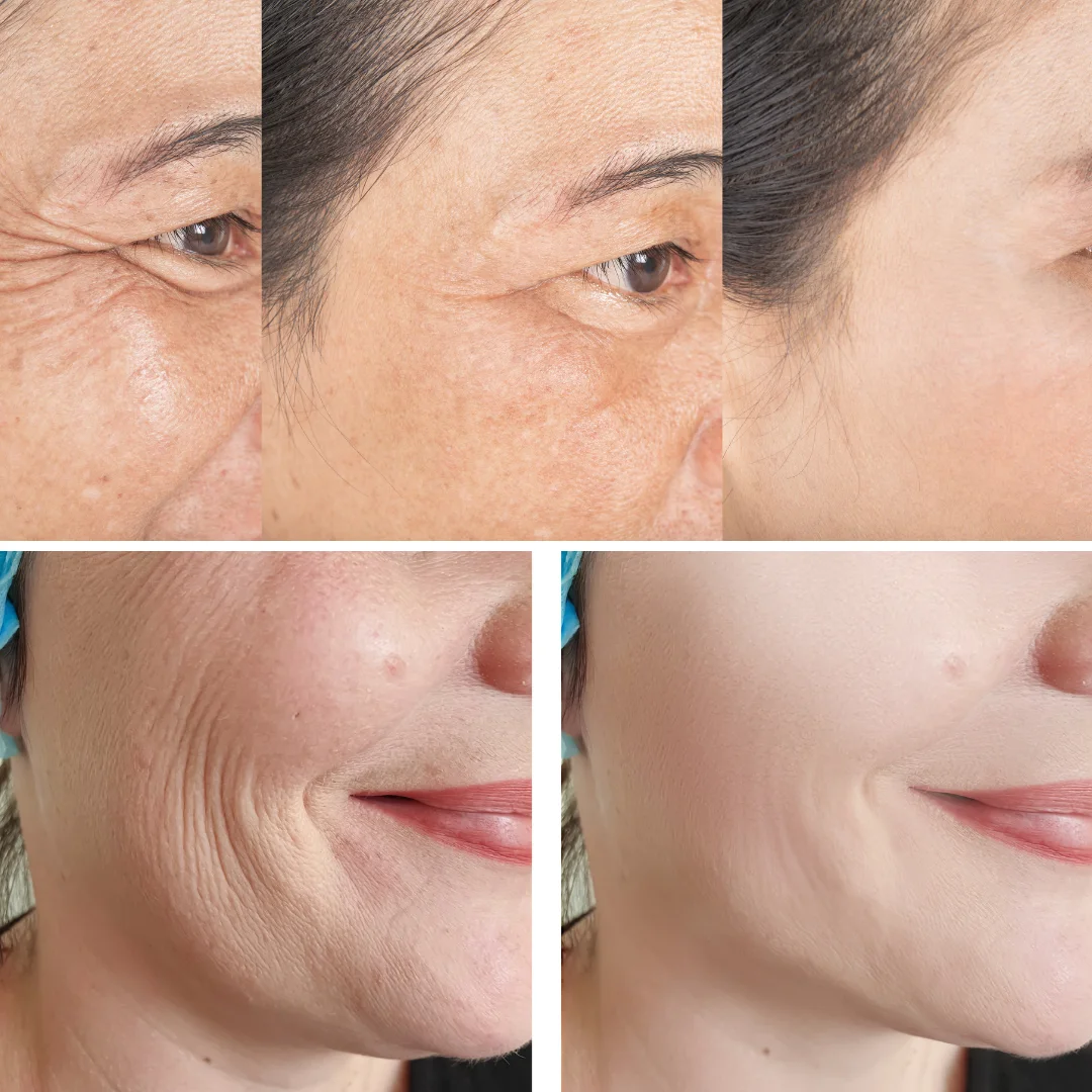 Pack Sérum Anti-Rides & Anti-Acné – Soin Complet pour une Peau Parfaite