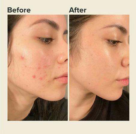 Rael Invisible Acne Spot Stickers – Absorbing Treatment