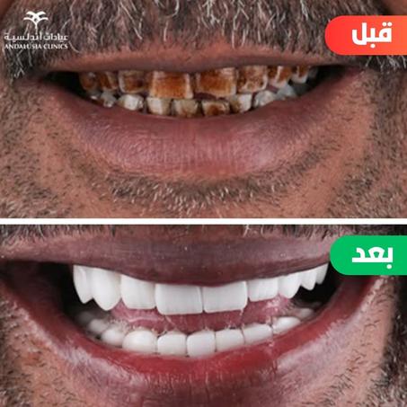 الحل السريع لإخفاء الفراغات والاصفرار فوراً.