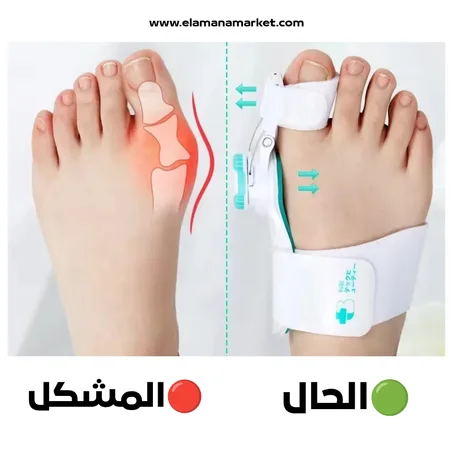 مقوّم و فاصل الأصابع الحل اللي غادي يغيّر حياتك بلا جراحة وبلا مصاريف خيالية