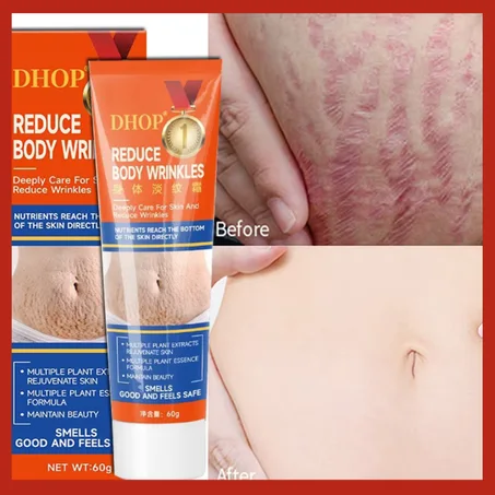 كريم إزالة تمدد جلد الجسم