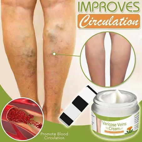 كريم الدوالي لعلاج الأوردة العنكبوتية-تخفيف الارجل المتعبة والثقيلة وتقوية صحة الشعيرات الدموية