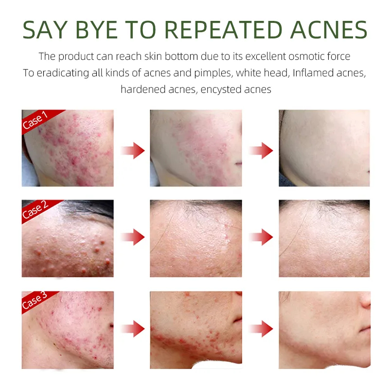 Acne Protection Cream