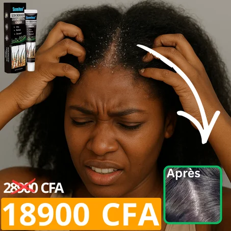 Crème naturelle pour traiter les pellicules et les démangeaisons excessives (Civ)