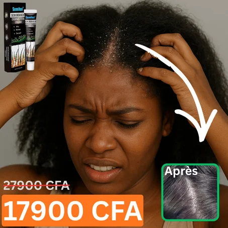 Crème naturelle pour traiter les pellicules et les démangeaisons excessives (Civ)