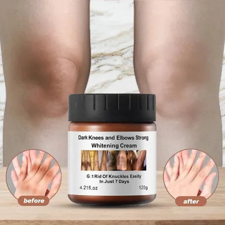 Dark Knees & Elbows Whitening Cream