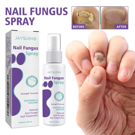 "Spray antifongique JAYSUING – La solution naturelle et sûre pour des ongles sains et beaux"