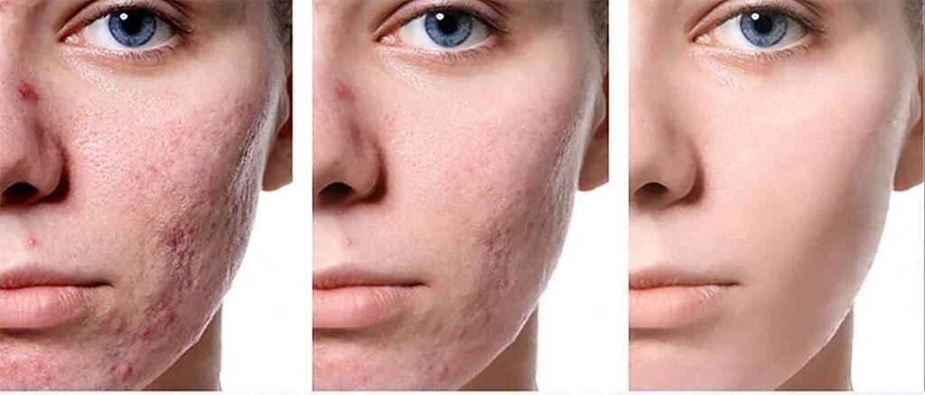 كريم إزالة الندبات السحري