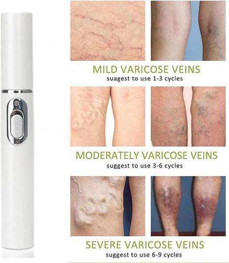 قلم علاج حب الشباب والدوالي الملولبة