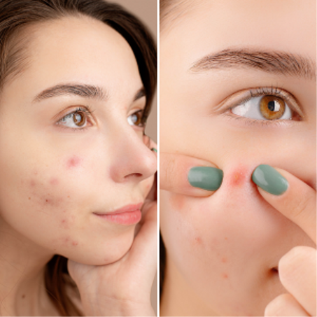 Peaux mixte , grasse , acné et à imperfection