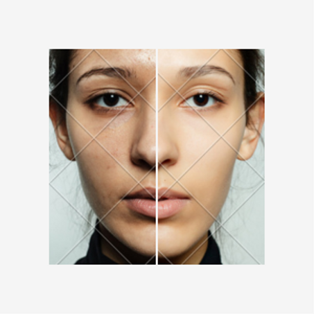 Anti-tache , dépigmentation