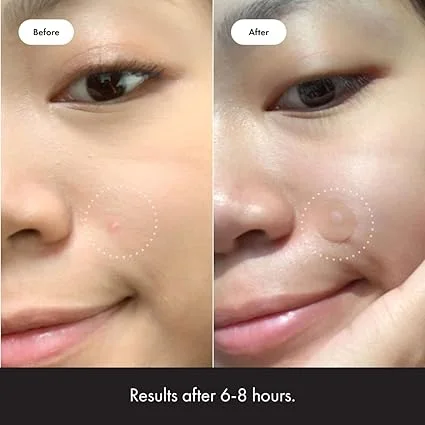 Mighty Patch™ Original هو منتج مبتكر من Hero Cosmetics مخصص للتعامل مع حب الشباب والبثور بشكل فعال وسهل. يعتمد على تقنية الهيدروكولويد لامتصاص الشوائب وحماية البشرة.