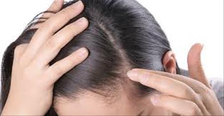 خليط من الزيوت والاعشاب الطبيعيه لحل مشكله تساقط الشعر عند النساء.