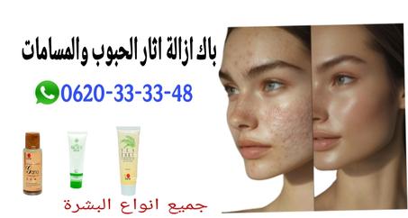 علاج اثار الحبوب في البشرة