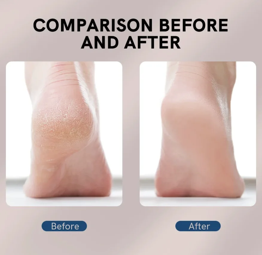 مقشر القدمين الكهربائي