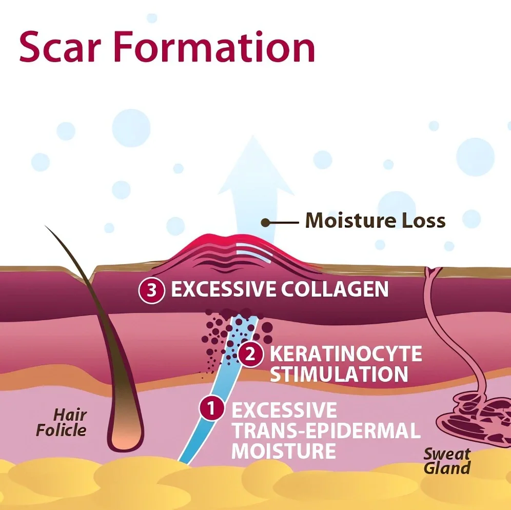 Spray nettoyant pour cicatrices et vergetures ScarRemove™