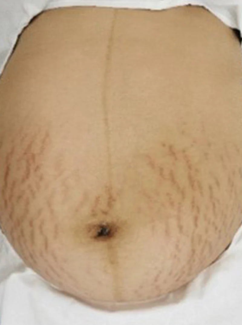 Spray nettoyant pour cicatrices et vergetures ScarRemove™