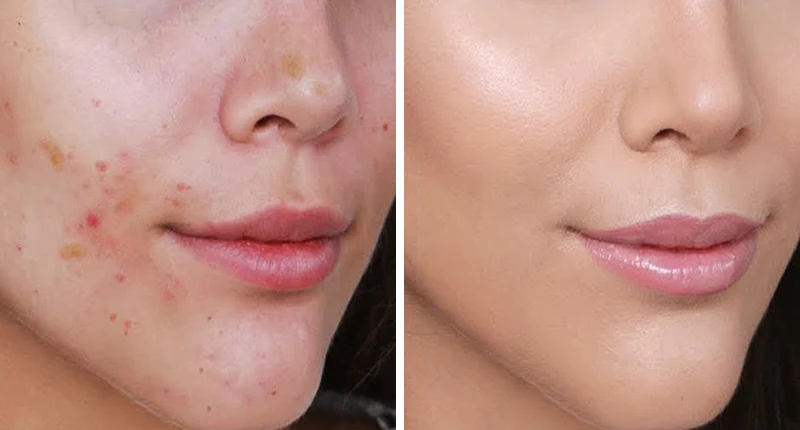 Spray nettoyant pour cicatrices et vergetures ScarRemove™