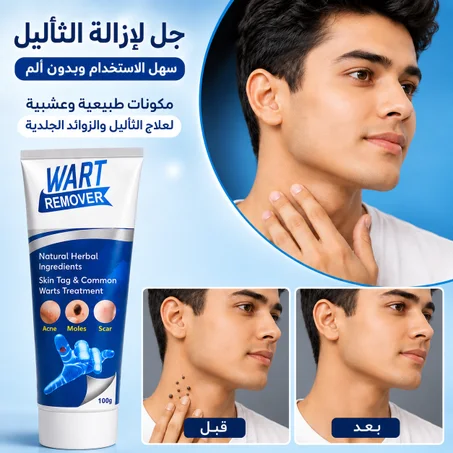 كريم لإزالة الشامة والثؤلول