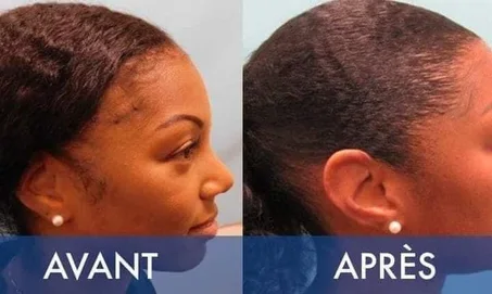 Huile pour faire pousser cheveux et barbe