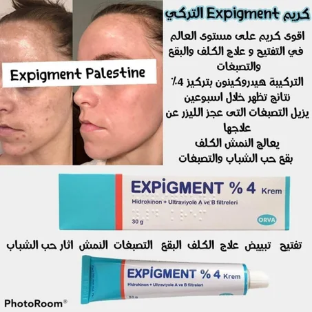 الكريم التركي الاكثر شهرة EXPIGMENT 4% لتفتيح البشرة و التخلص من الندبات