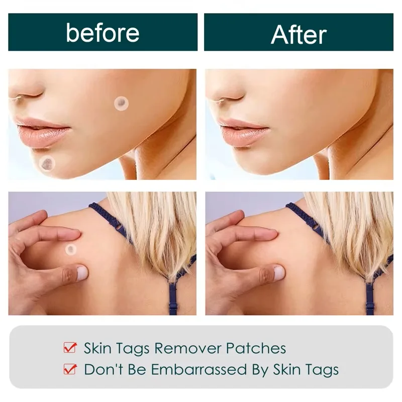 لاصقات لإزالة الزوائد الجلدية
