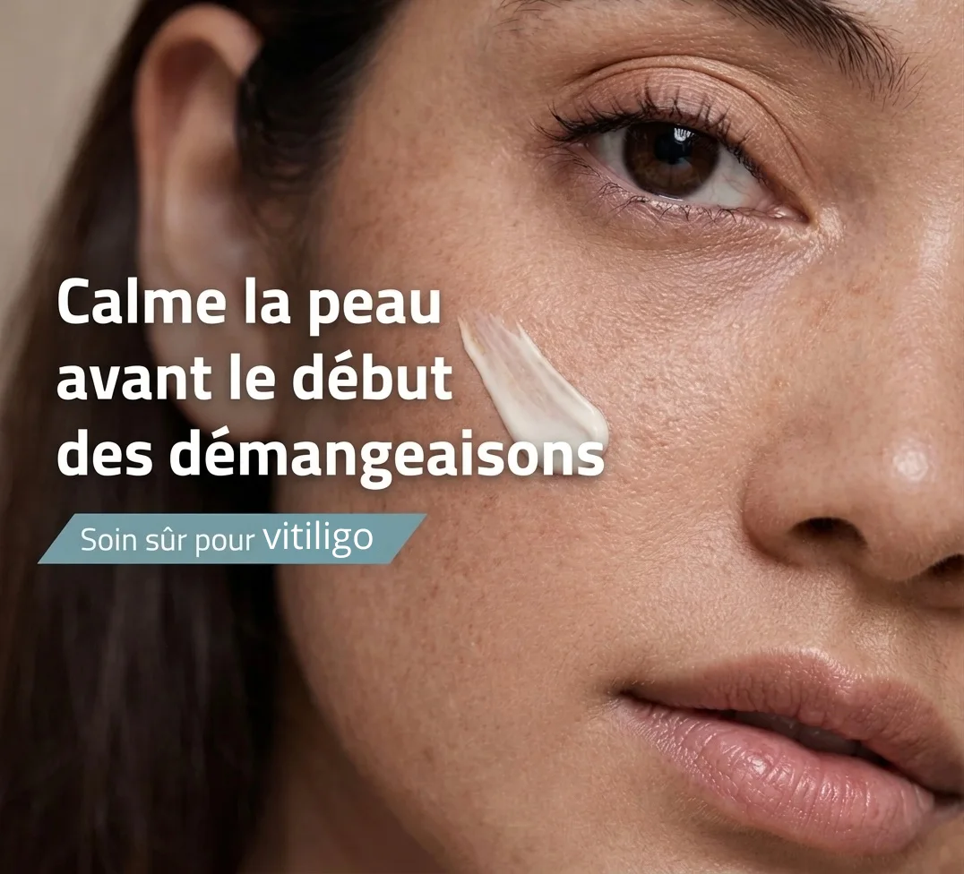 VITILIGO CREAM ODAFLOR