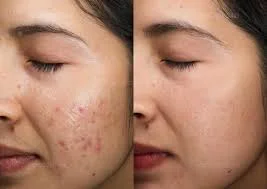 NIACINAMIDE ODAFLOR (copy)