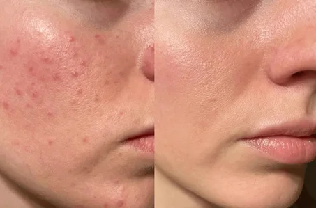 NIACINAMIDE ODAFLOR (copy)