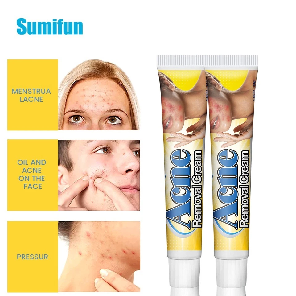 كريم إزالة حب الشباب من Sumifun - علاج فعّال وآمن للبشرة المعرضة لحب الشباب - يرطب، يفتح، ويزيل البقع خلال 4 أسابيع